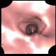 Stenosis of trachea, tracheal intubation, virtual tracheoscopy: CT - Computed tomography